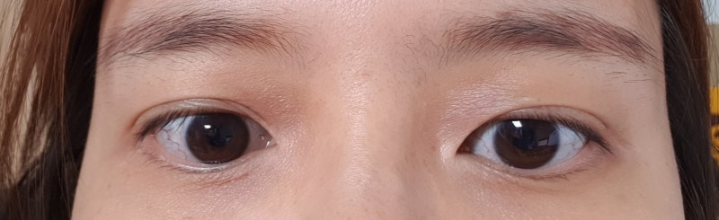 알레르기성 눈가 염증, 눈가 아토피 치료후기 & 바르는 연고, 오일밤, 아토피화장품 추천! (눈....