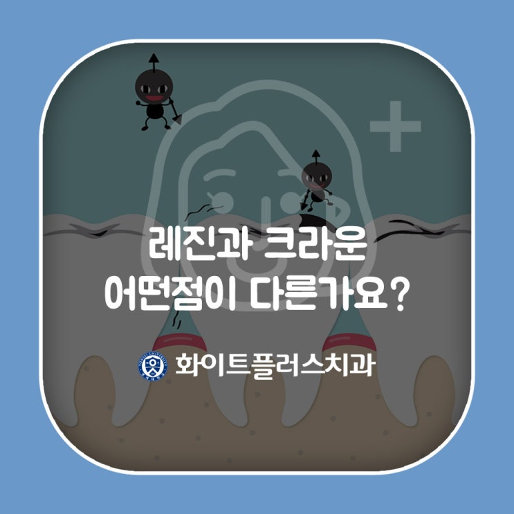 레진과 크라운 어떤점이 다른가요?