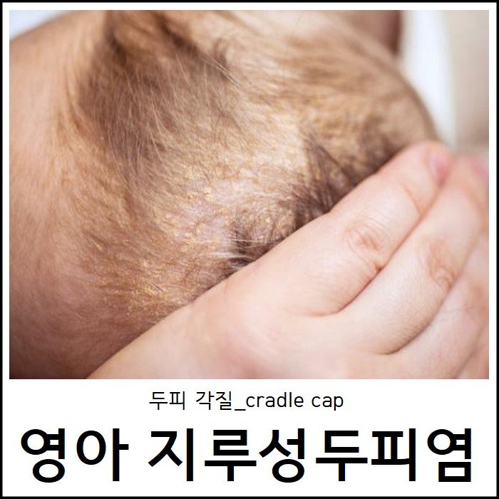 천안지루성피부염치료 세정제 바꿔보아도 3