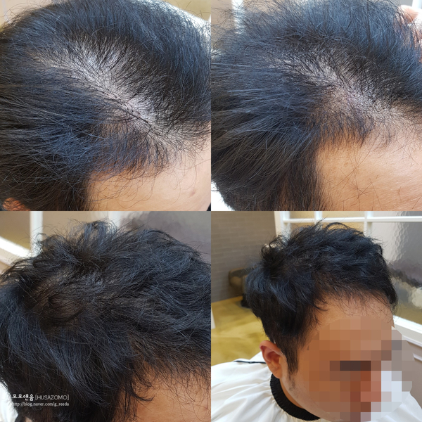  [모모앤윰-증모이야기] 결혼 앞 둔 예비신랑 헤어스타일!! 탈모있는 예랑 고민해결!!