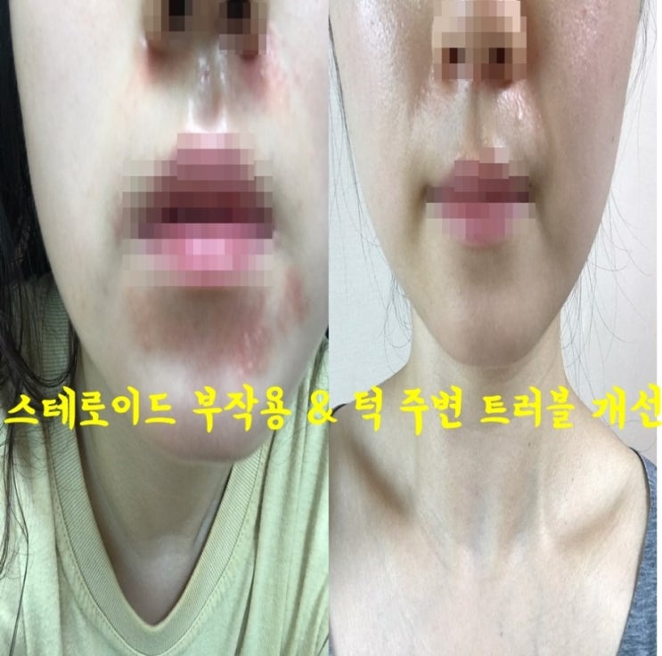 #예작화장품 지루성 피부염 & 스테로이드 부작용 & 입과 턱 주변 트러블 개선