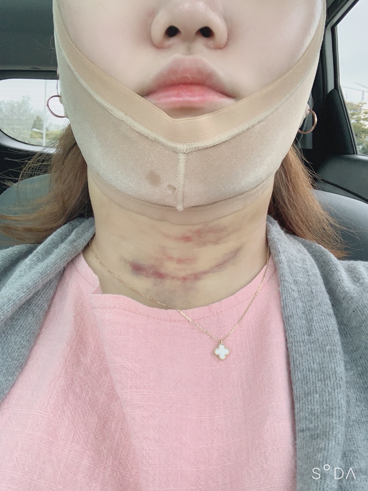  얼굴지방흡입 으로 이중턱 증발함 ㅠㅠ(내돈 후기)