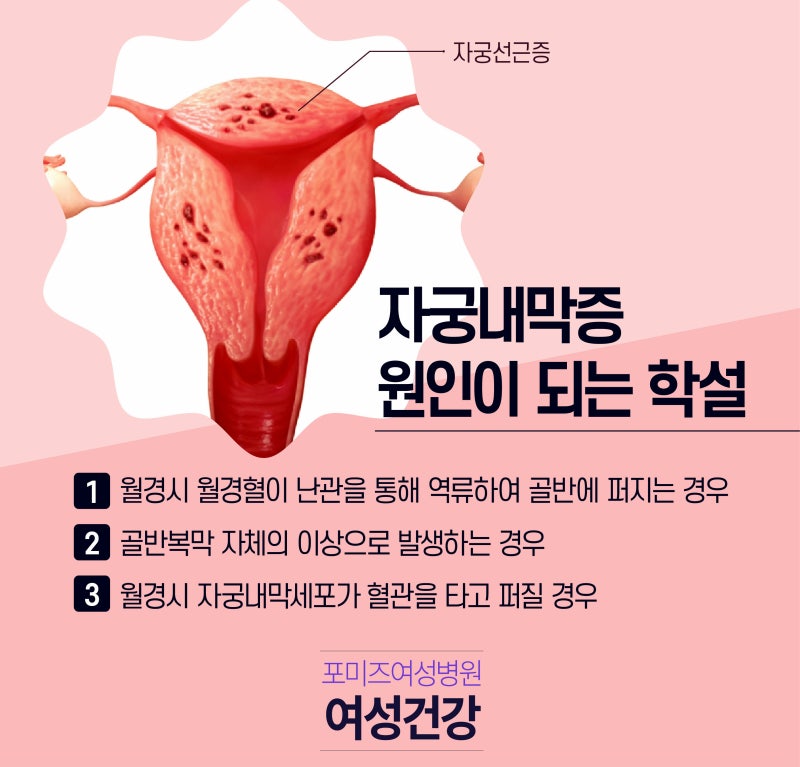 자궁내막증 자궁근종원인증상치료 불임의 원인 자궁내막증