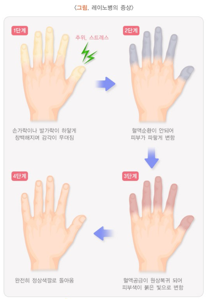  레이노병은 어떤 병? & 조민아 레이노 병 악화 - 조민아는 누구인가?