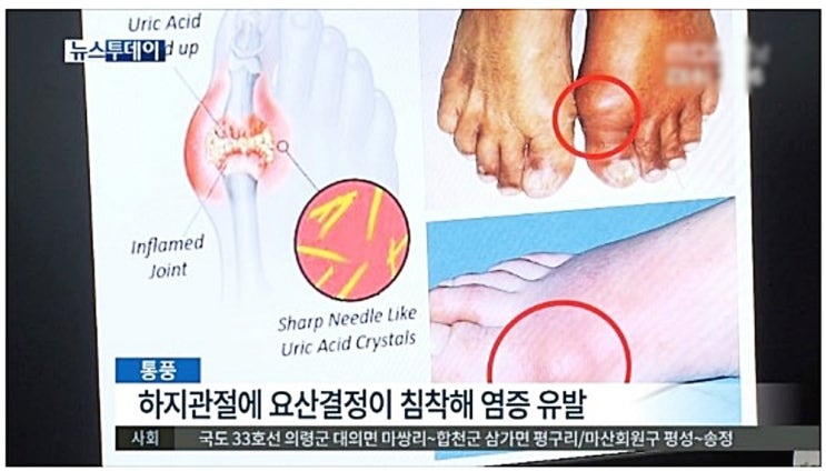  통풍 통증 완화법, 알칼리성 복합식품이 주목받는 이유