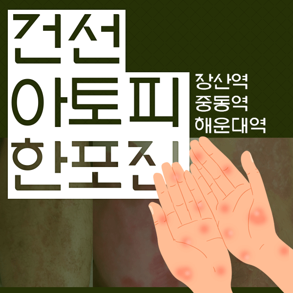  한포진물집 / 무료샘플신청 재발걱정없는 탁월한선택!