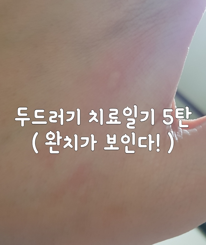  다형홍반 두드러기(담마진) 극복 치료 후기 5탄 :: 치료중 :: 만성두드러기 :: 완치가 보인다! :: 두드러기 상태 변화