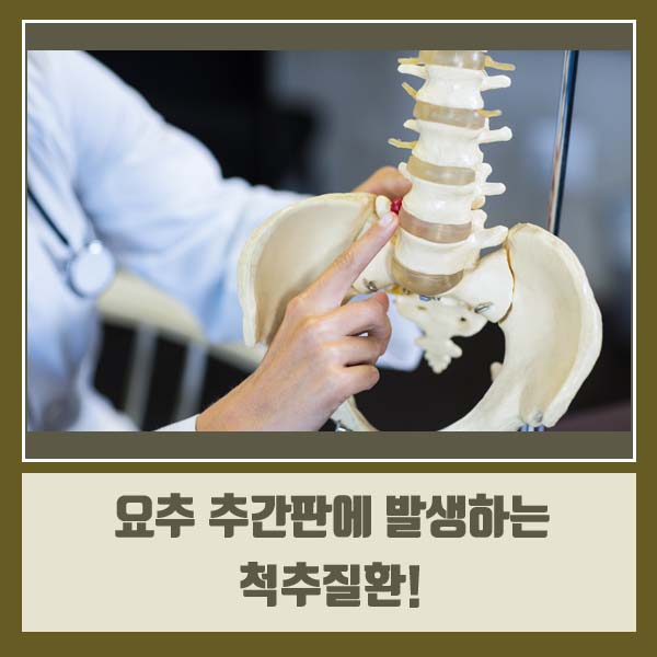  봉담신경외과 원인 모를 허리 통증에는 다양한 척추질환을 의심해야 합니다! <동탄시티병원>