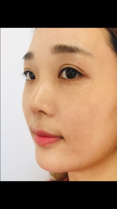  기미잡티제거 청라라임피부과의원 놀라운 효과