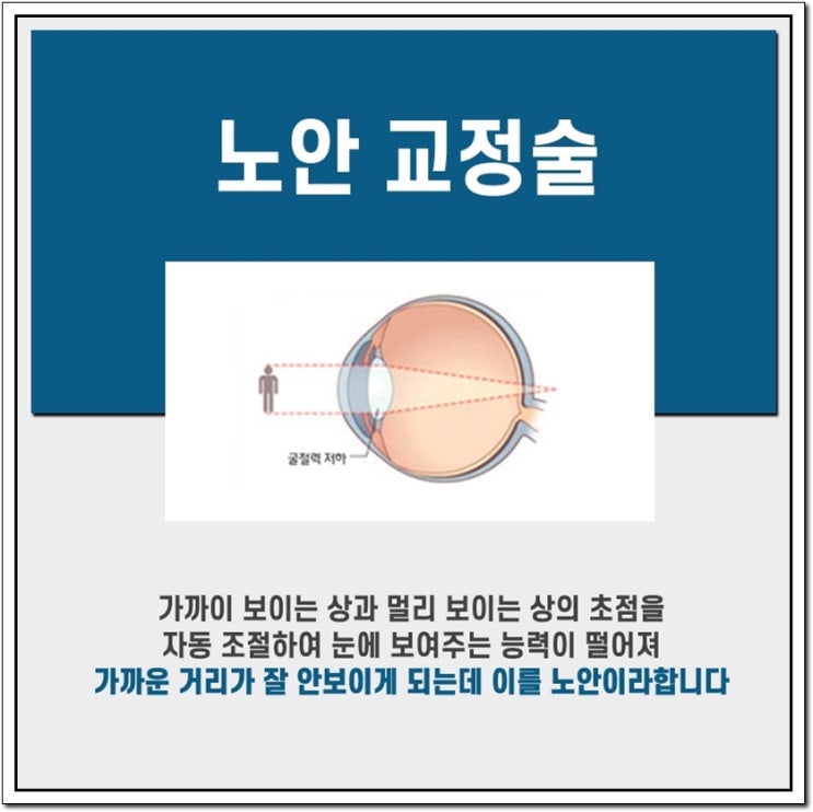  노안수술후기 비교하면서 교정진행