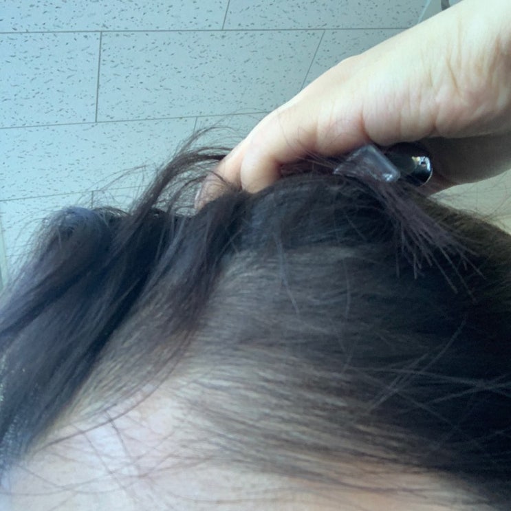  탈모약 부작용 제대로 알고 사용해야해요