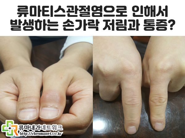  자가면역질환으로 발생하는 관절염 방치하지마세요!