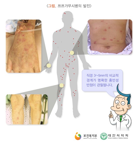  가을철 조심해야할 질병, 쯔쯔가무시 증상