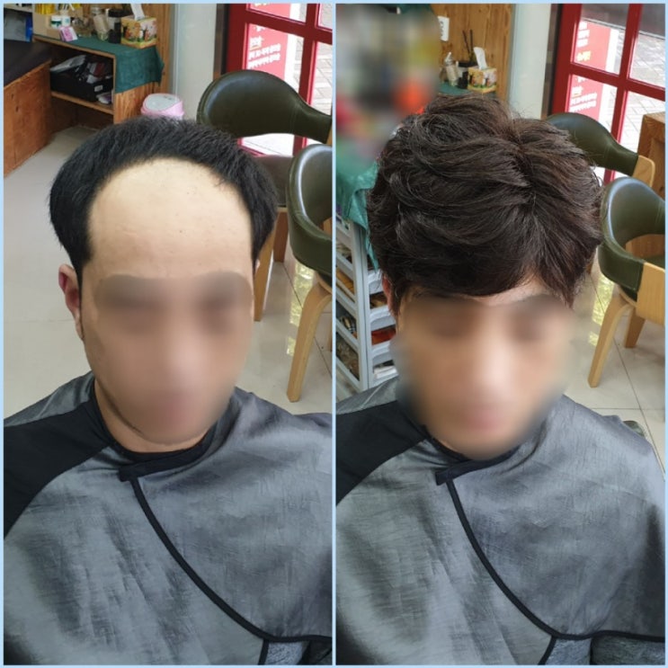 두피가 숨쉬는 헤어이식커버증모술로 해외출장도 OK [춘천가발김호증모]