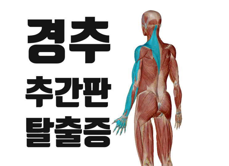 목디스크-날개뼈 안쪽이 아프고 팔이 저려요[영통 새움한의원]