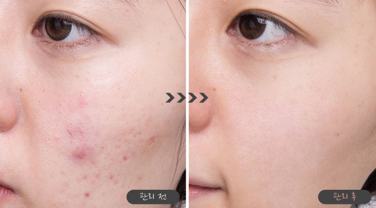  여드름 패치 사용전후 평소 관리팁