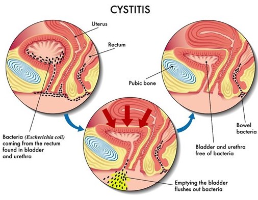  여성 방광염, 요로감염, 세균성 질염 관리에 도움되는 크랜베리와 유산균 락토바실러스 액시도필러스 균주
