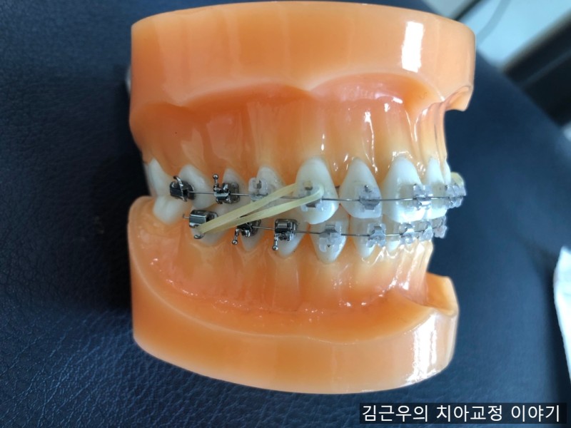 치아교정 중 고무줄 걸기 : 네이버 블로그