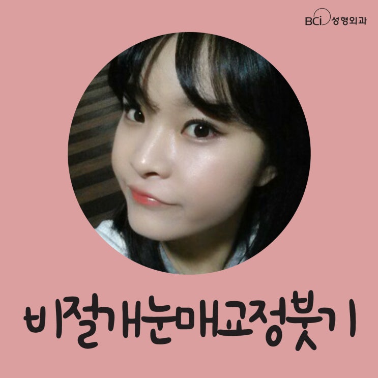  비절개눈매교정붓기 언제쯤 가라앉나요?