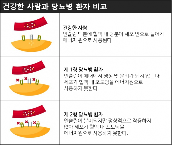  [ 당뇨와 운동 ][ 수내 운동 ][ 수내동 헬스 ] 허벅지 1cm감소하면 당뇨 걸릴확률이 9.8배?
