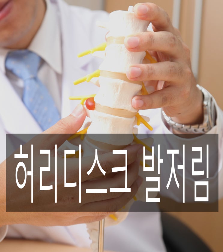  허리디스크발저림, 다리저림 원인과 치료법은?