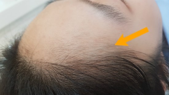  [대전풀페스왁싱] 둔산동 이마왁싱으로 볼록한 이마 완전 강추해드립니다.