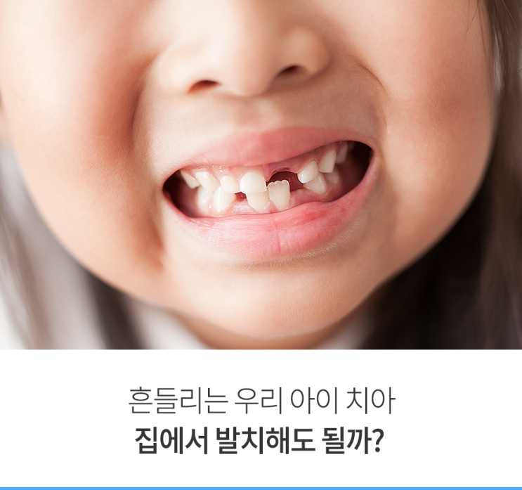  흔들리는 우리 아이 치아. 집에서 발치해도 될까?