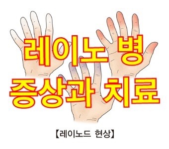  레이노병 원인 증상 치료 수술