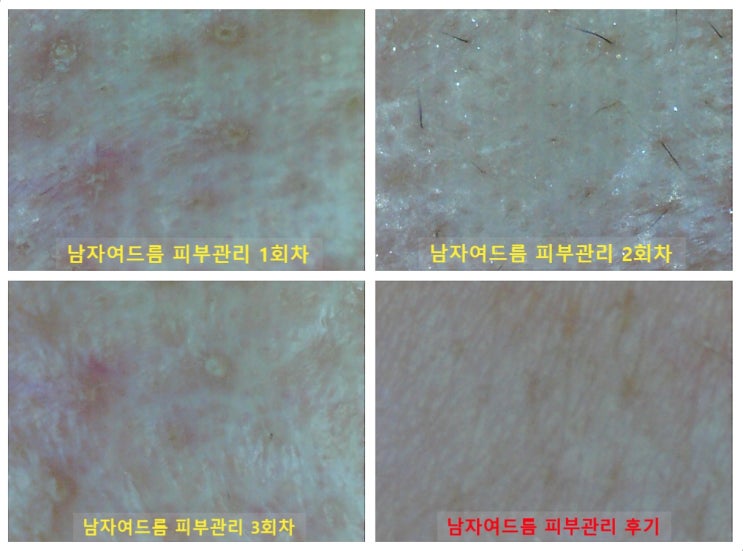  김포 남자여드름 피부관리 압출까지 김민희스파유르에서 깔끔해진 피부