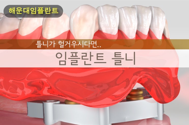  해운대치과: 틀니가 헐거우시다면.. 임플란트 틀니