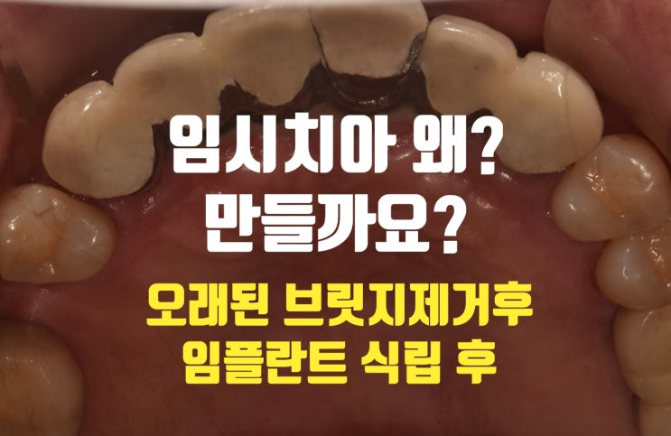  요즘은 컴퓨터이용해서 어금니 앞니 임시치아 만드는시대