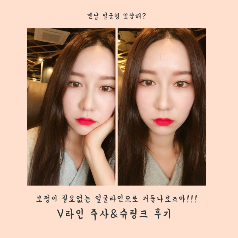 [장성규를 아이돌 얼굴형으로 만든 슈링크 후기 궁금하지않아? 불독 얼굴형 나도 해본 V라인 ....