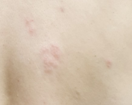  내가 대상포진이라니? (초기증상, 좋은음식)