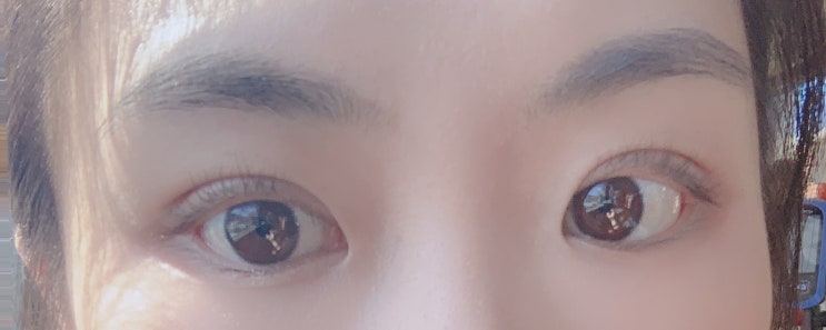  [쌍꺼풀후기] 부제:누가 쌍커풀 수술이 간단한 시술이라고 했는가.. 생생한 자연유착 쌍커풀 수술후기