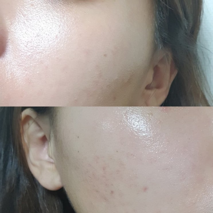 건조해서 생기는 피부간지러움 뉴트로지나소프트밤으로 해결!