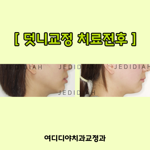  신림치과 덧니교정전후 비교사진