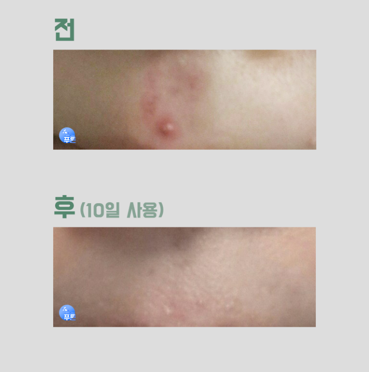  여드름치료 병원용 화장품 하우트겐스팟&하우트겐폼크림 솔직 후기