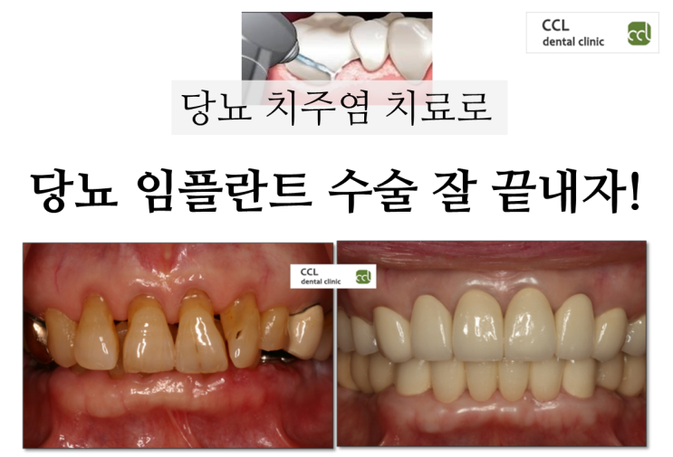  당뇨 치주염 치료로 당뇨 임플란트 수술 잘 끝내자!