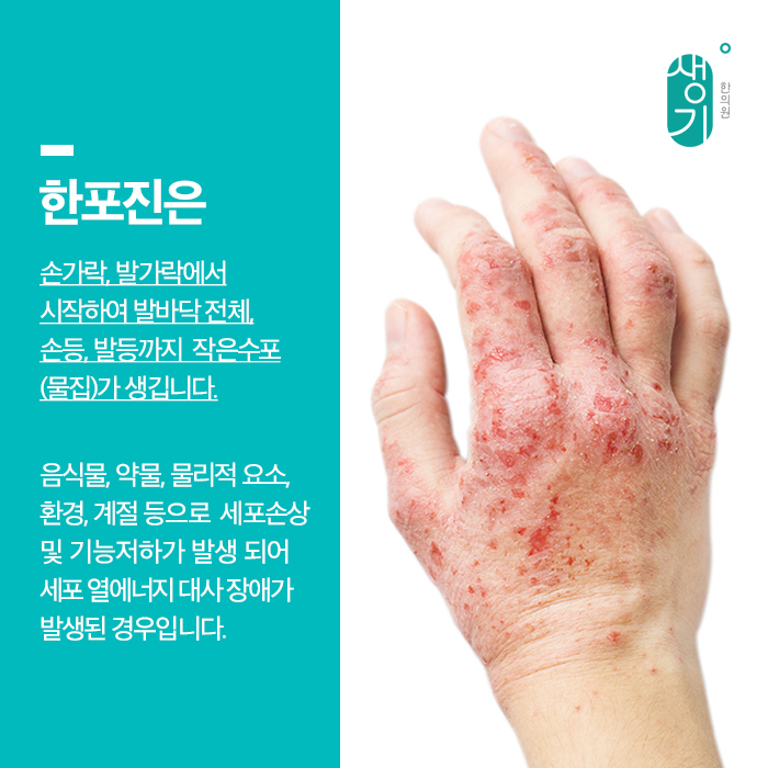  서면한포진. 한방피부과에서 치료받자