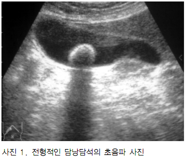  [담낭 담석] 담즙의 구성, 담석의 종류, 담석의 진단, 콜레스테롤 및 색소성 담석 정리