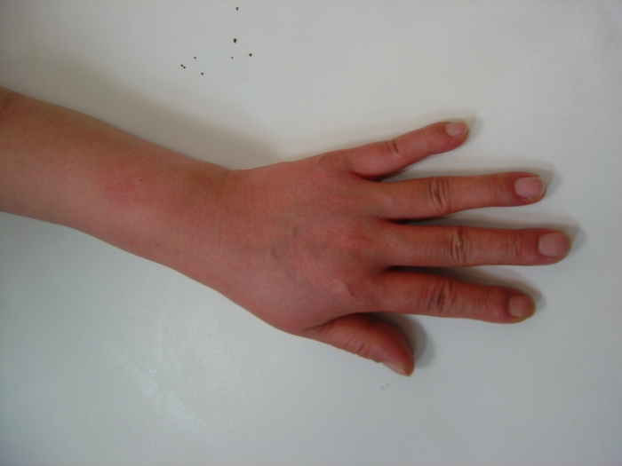  복합부위통증증후군(CRPS) 산업재해