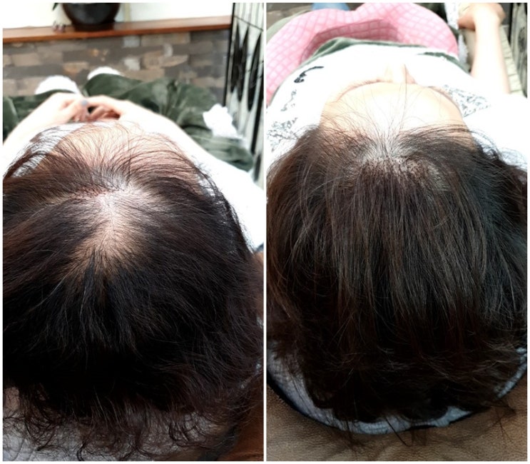  인천증모술로 여자정수리탈모 한방 해결