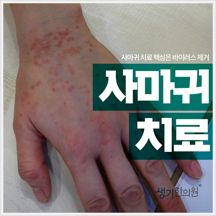  사마귀없애는법 궁금한 사항들!