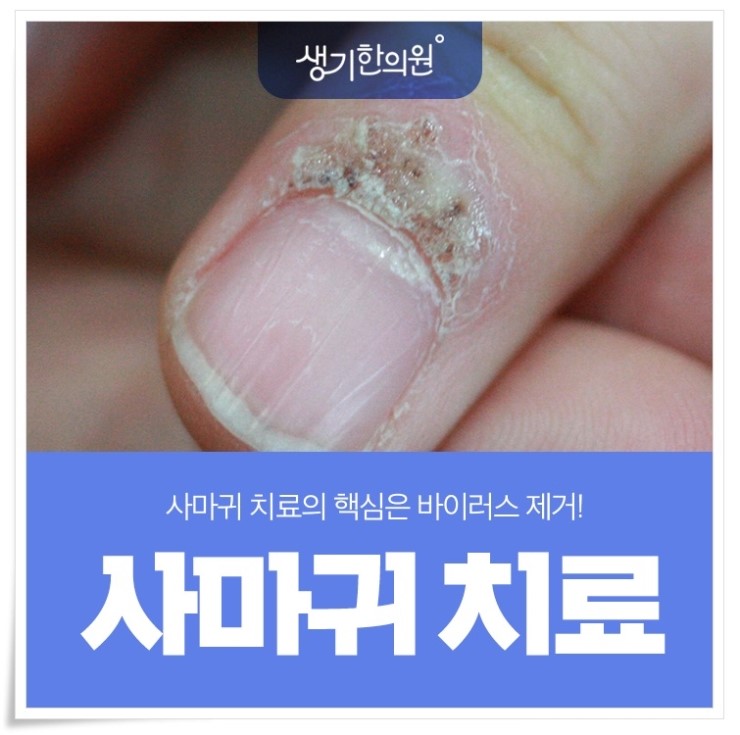 수원사마귀한의원 안심한다면