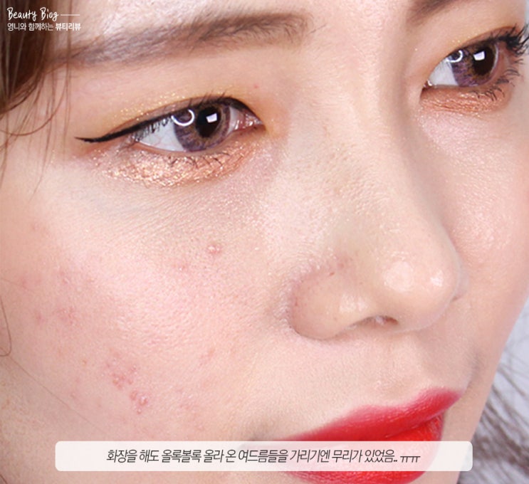  성인여드름 원인 케어법, 정말 쉽고 간단한 관리법 공개