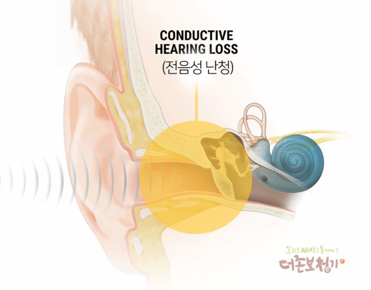  감각신경성 난청과 달리  수술치료가 가능한 병변, 전음성 난청 (conductive hearing loss)