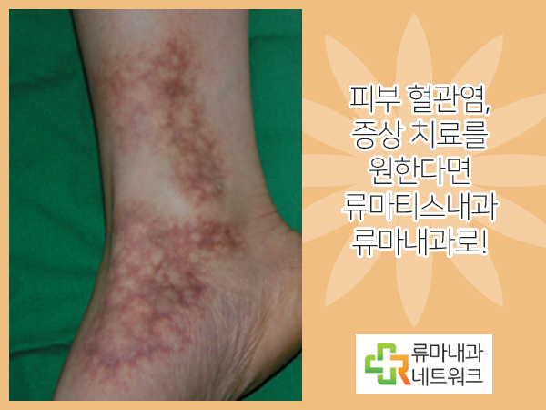  피부혈관염 치료 이런 증상 있을 때를 주의하세요!!