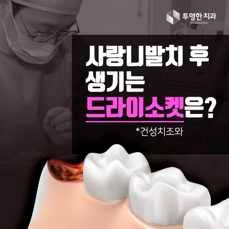  치과에서 자주 묻는 질문 4 - 사랑니 발치 후 생기는 드리이소켓(건성치조와)란 무엇인가?