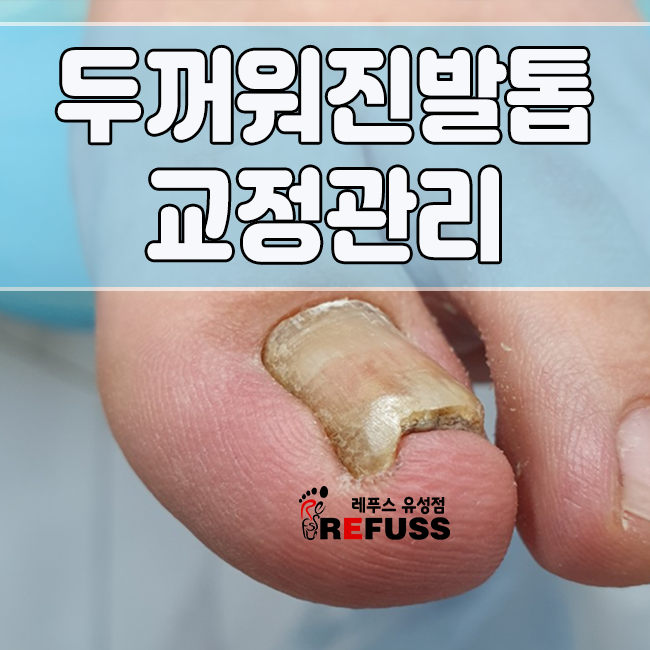 대전 내성발톱 무좀으로 두꺼워진 발톱 관리 어떻게 하나요?