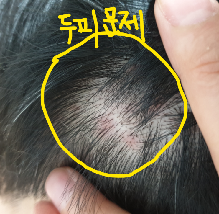  머리 떡졌을때 두피로션 바른다고요? (어이없을無)